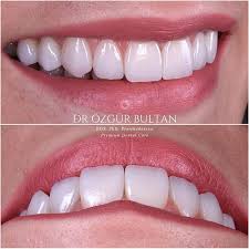 Pin By Kristina Serbedzic On Dentistry Smile Makeover Esthetic Dentistry Dental