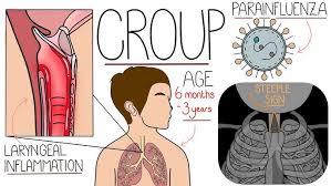 Image result for Croup
