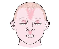 Image result for Nevus Simplex