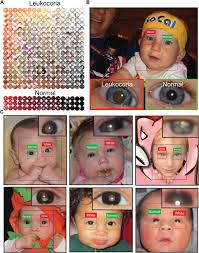 Autonomous Early Detection Of Eye Disease In Childhood Photographs Science Advances