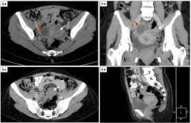 Endometriosis affects an estimated 176 million women worldwide regardless of their ethnic and many remain undiagnosed and are therefore not treated. Endometriosis Different Locations And Faces Seen By Ct And Mri Semantic Scholar
