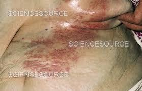 Image result for Intertrigo under breasts