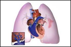 Nice 2018 Guideline For Managing Pulmonary Hypertension And Cor Pulmonale