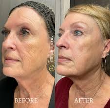 Add a dermaplane to your facial and thank us later✨ 🪦Dead skin? Gone. 🍑  Peach fuzz? See ya. ✨Glow? Unlocked. 🧴Better product absorption? Always.  💄Smoother makeup? Say less. It's the cherry on