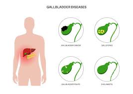 Image result for Biliary Colic