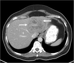 A breast computed tomography (ct) scan is a medical imaging study of the breast offering a view in three dimensions. Breast Mass Found On Ct Scan Ct Scan Machine