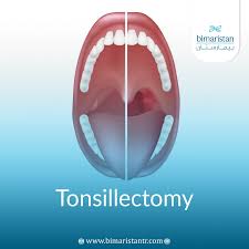 Image result for Tonsillectomy