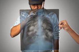 Pencegahan Kanker Paru-paru yang Efektif - Hello Sehat