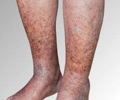 Image result for Stasis Dermatitis