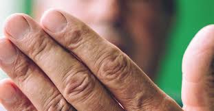 Image result for brown patches on the feet