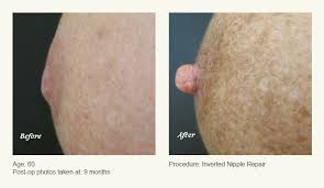 Image result for Nipple Inversion
