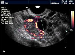 Image result for corpus luteum sonography)