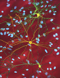 Huntington S Disease Wikipedia