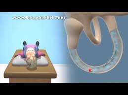This video demonstrates how to perform a modified epley maneuver to treat right posterior canal bppv canalithiasis. Fauquier Ent Epley Maneuver To Treat Bppv Vertigo Facebook