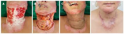 It's commonly seen with pressure ulcer wounds (bedsores). One Stage Reconstruction Of Neck Burns With Single Layer Dermal Matrix