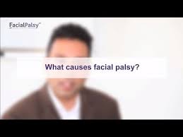 The exact cause of bell's palsy is not known. Bell S Palsy Facial Palsy Uk