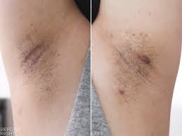 Ingrown hairs can happen anywhere hair grows on the body. Tria Hair Removal Laser 4x Smoothstart Calming Gel Before Lavenderlilac Dream