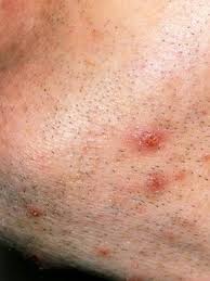 In its general sense, it is a type of skin infection that appears in the shape of a bump sometimes filled with puss on your skin on the. What Is That Skin Growth Skin And Beauty Center Everyday Health