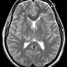 Image result for Diffuse Axonal Injury