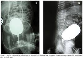 Image result for Voiding Cystourethrogram