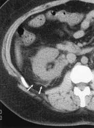 Image result for Helical CT Urogram