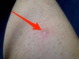 Acids in topical products loosen the outermost layer of skin cells and work to both prevent and treat ingrown hairs at the same time. How To Prevent Ingrown Hairs