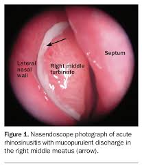 Image result for Rhinosinusitis