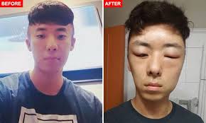 Also we have a big announcement. Korean Man S Head Balloons After Dyeing Hair In Salon