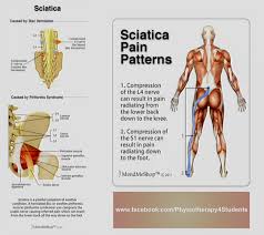المعالجة الفيزيائية students عرق النسا العصب الوركي sciatica هذا هو المصطلح المستخدم من الشخص العادي غير المتخصص لوصف مشكلة شائعة بالظهر وهو بذلك ليس تعريفا علميا لأية