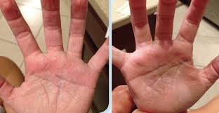 Excessive Wrinkles And A Burning Sensation In A Girl S Hands After Bathing Consultant360