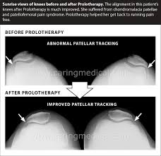 Treating Patellofemoral Pain Syndrome And Chondromalacia Patella Caring Medical Florida
