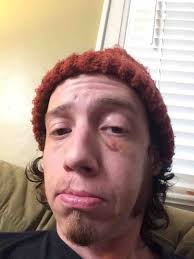 Fundraiser by Shade Kling : Shade Needs Surgery