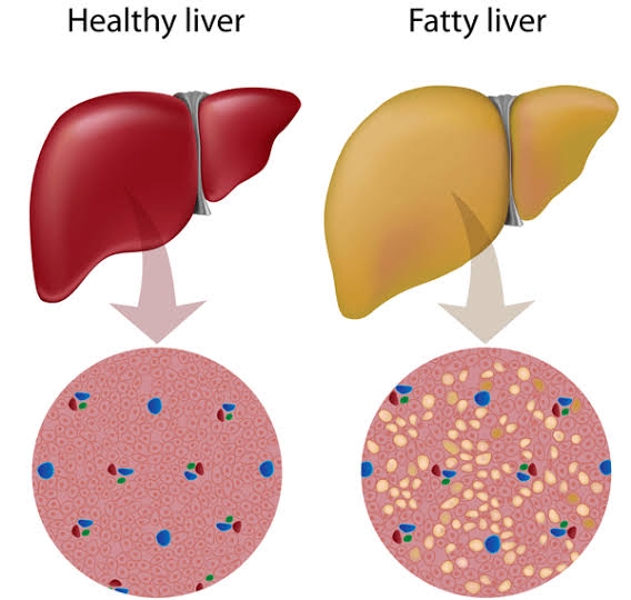 Résultat de recherche d'images pour "remove liver fat""