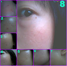 T3 pimple gel +15g (new) is specially formulated with natural australian tea tree oil, canadian willow herb extract and. Great Skinandlife Review On Hoe T3 Mycin Clindamycin Gel 1