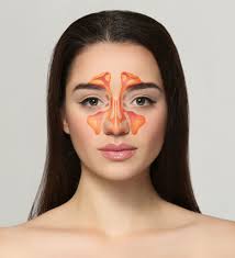 Polyps usually occur in individuals with asthma or allergic rhinitis and can contribute to worsening sinus conditions. Chronic Sinusitis Chitogel