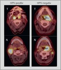 Hpv A Different View On Head And Neck Cancer Abstract Europe Pmc