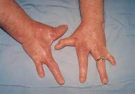 Ectrodactyly Ectodermal Dysplasia And Clefting Syndrome Springerlink