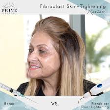 “My clients are tired of botox needles so #fibroblastskintightening is a  great alternative,” said our ex trainee and now specialist Samia Rivera.  Checkout what else she has to say about this #great ...