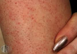Have You Ever Noticed Dry Rough Sometimes Red Tiny Bumps On The Backs Of Your Arms Thighs Knees Or But Keratosis Pilaris Keratosis Pilaris Treatment Skin