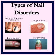 Image result for Acral lentiginous melanoma nail