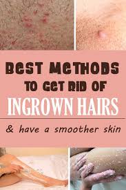 Ingrown Hairs What They Are And How To Get Rid Of Them Missingbeauty Com Treat Ingrown Hair Ingrown Hair Ingrown Hair Remedies