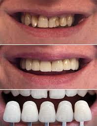 Yaprak Dis Yaprak Dis Fiyatlari Istanbul Smile Center