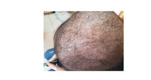 Dr. Donovan's Hair Loss Articles (2011-2024) — Donovan Hair Clinic