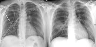 By the end of this lecture the students must know; Portable Chest X Ray In Coronavirus Disease 19 Covid 19 A Pictorial Review Clinical Imaging