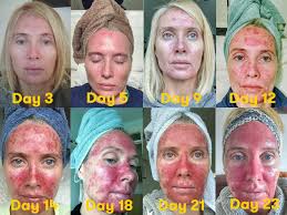 22.02.2011 · skin cancer treatment varies greatly and depends on the size, type, depth, and location of the lesion(s). These Graphic Photos Of Skin Precancer Treatment Are A Must See Self