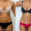 During the liposuction procedure, small incisions are made in order to remove the excess fat cells. Https Encrypted Tbn0 Gstatic Com Images Q Tbn And9gcqmqk8hyn3mkoxirgwpfe4puwvyy2addymigpodhd4 Usqp Cau