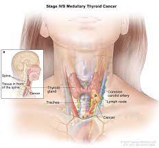 Thyroid cancer typically doesn't cause any signs or symptoms early in the disease. Selpercatinib Approved For Thyroid And Lung Cancers National Cancer Institute