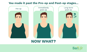 Weight loss surgery, also known as bariatric surgery, refers to a variety of procedures that help you lose weight by making changes to your digestive system. How To Lose Weight After Gastric Sleeve Surgery Long Term Weight Loss My Gastric Hub