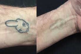 A search for tattoo removal online can return a paralyzing number of options. Tattoo Removal Hypopigmentation And Hyperpigmentation Removery