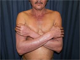 Image result for Photodermatitis